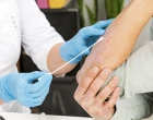 psoriaszis