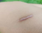 jizva
