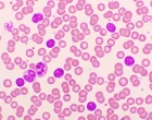 Venetoklax v léčbě relabující/refrakterní CLL – data z reálné klinické praxe