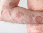 psoriaza