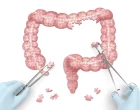 ulcerative colitis v