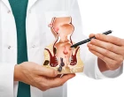 rectal cancer