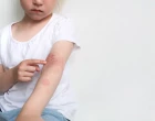 dívka s atopickou dermatitidou na rukou