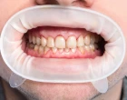 Hypomineralizace molárů a řezáků