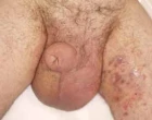 penis