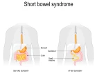 Short bowel syndrome