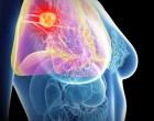 grafika_ilustrace_tumor_prso_rakovina_prsu