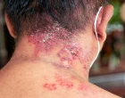 INFECTION ON THE BODY
