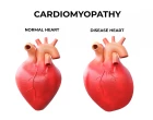 kardiomyopatie 2