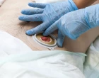 nurse stoma