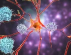 amyloid
