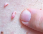 hpv papilomavirus