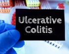 ulcerative colitis33