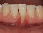 gingivitidou