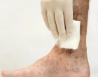 leg ulcers