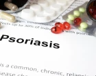 psoriasis treatment