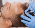 Klinické zkušenosti s injekčním HTI kolagenem v terapii alopecie