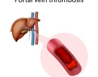 Trombóza portální žíly