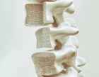 Diagnostika osteoporózy v kontextu současných doporučení