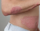 psoriaza1