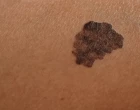 AI v klinické dermatologii? Nový model pomůže s diagnostikou