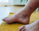 TEWL jako nový prediktor recidivy diabetických ulcerací na noze