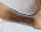 chronic venous insufficiency