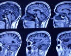 MRI scan 25