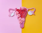 Endometriosis