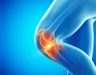 osteoartróza kolene