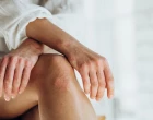 Kombinace psoriázy a axiální PsA u mladé ženy: rychlý, výrazný a trvalý efekt díky bimekizumabu – kazuistika
