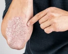 psoriaza