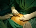 Open abdomen