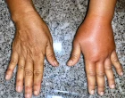 edema, hereditarni angiodem