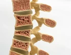 Osteoporoza kost