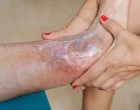 Zetuvit Plus Silicone Border a jeho vliv na kvalitu života pacienta s chronickou ránou