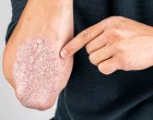 psriasis