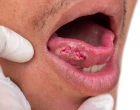 oralni lymchem