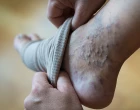 compression stocking on her leg