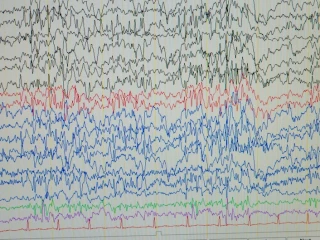 Srovnání účinnosti bukálního midazolamu a rektálního diazepamu v léčbě dospělých se sériovými záchvaty nebo status epilepticus