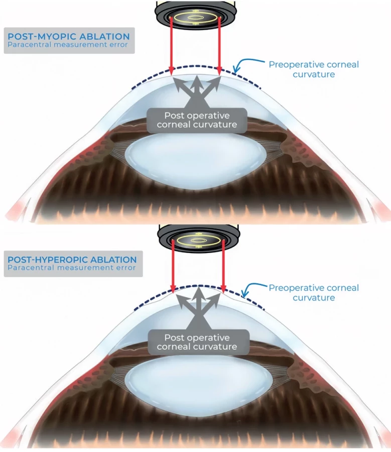 Hyperpic Determination of Corneal Power after Refractive S... | proLékaře.cz