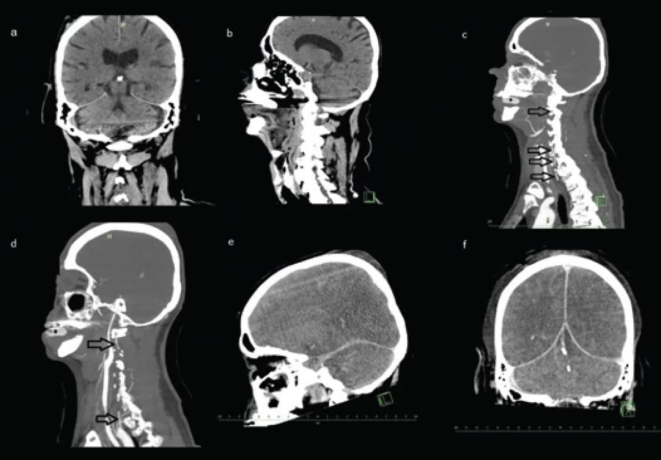 Traumatic bilate... | Česká a slovenská neurologie a neurochirurgie