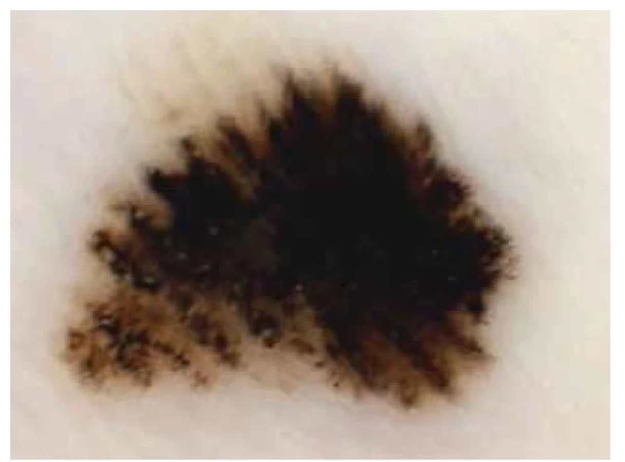 Dermatoskopie v „netypických“ lokalizacích: ploché... | proLékaře.cz