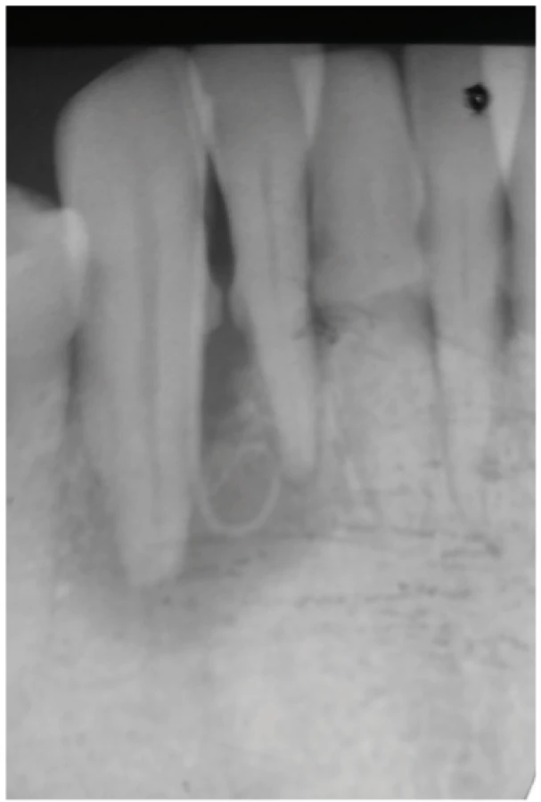Periapical radiograph of tooth 43
