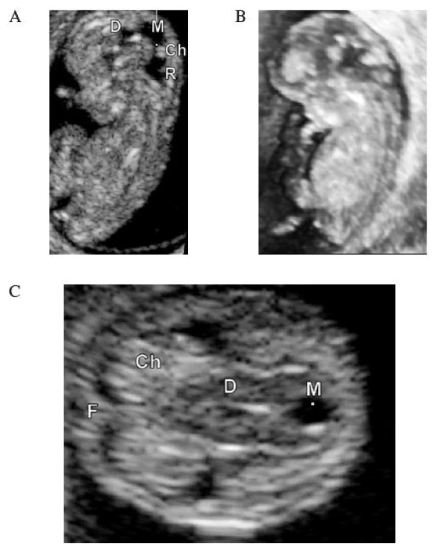 UZ zobrazení embrya v 11. týdnu. 2D obraz (A), 3D rekonstrukce (B), transverzální řez v úrovni III. komory (C). CRL = 35,4 mm.
D – diencefalon (III. komora), M – mezencefalon, R – rombencefalon (IV. komora), Ch – choroidní plexus postranní komory, F – falx cerebri