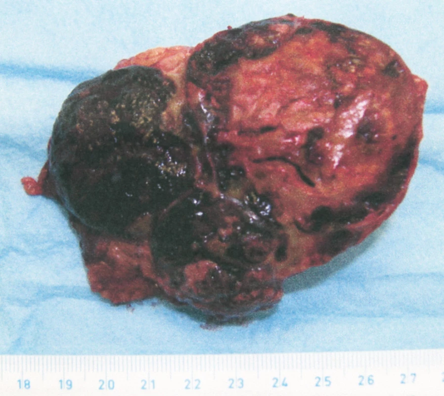 Řez preparátem, histologicky karcinom kůry nadledviny (CT viz obr. 3)
Fig. 6. Histological section through the specimen, carcinoma of the adrenal cortex (CT – see Fig. 3)
