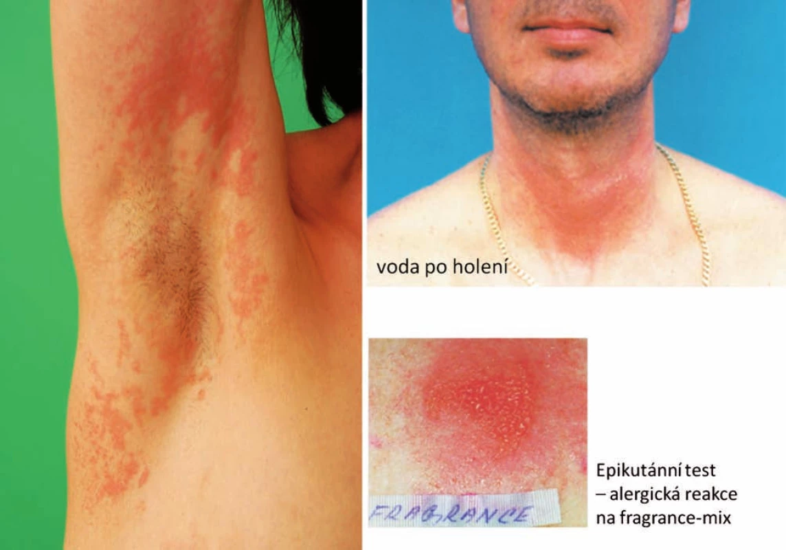 Eczema contactum – fragrance-mix