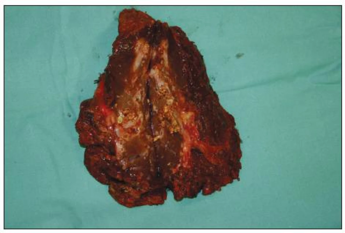 Resekát jater (6. a 7. segment) s dilatací žlučovodů a mnohočetnými konkrementy
Fig. 4. Resected tissue underwent liver (6<sup>th</sup> a 7<sup>th</sup> segment) with dilatation of bile duct and multiple stones