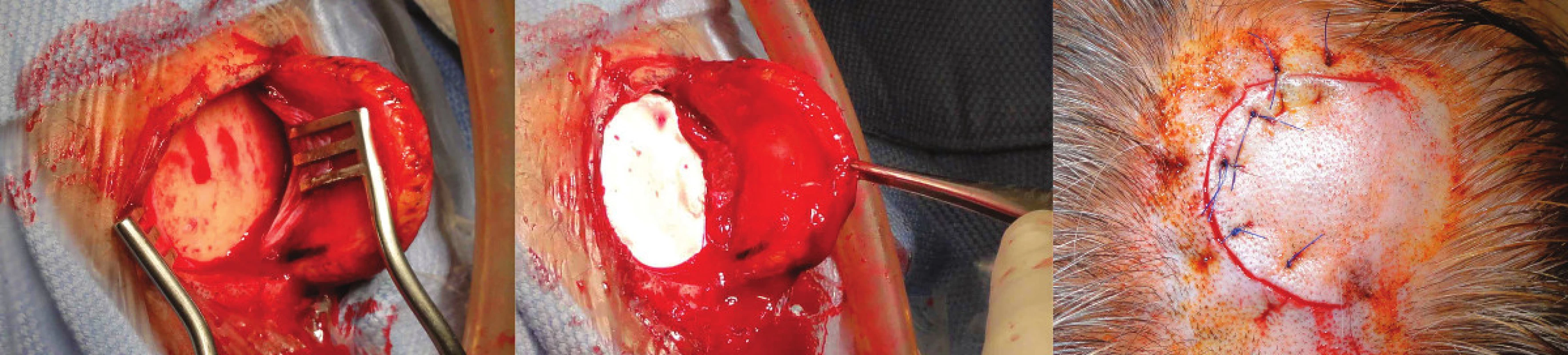 Implantace telemetrického ICP čidla (Neurovent-P-tel) – poloobloukovitá incize, kdy je pak přes trepanační návrt zavedeno čidlo do mozkové tkáně
Fig. 1: Implantation of the telemetric ICP sensor (Neurovent-P-tel) – a semi-arc incision with introduction of the sensor into the brain through a burr hole
