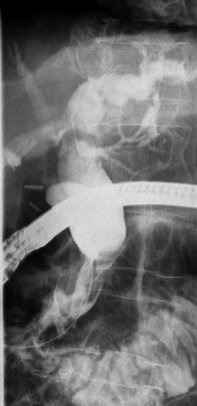 ERCP nález.
Fig. 1. ERCP findings.